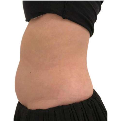 Beautywaves-Praxis-für-nicht-invasive-Behandlungen-Hautstraffung-Körperformung-HIFEM-Shockwave-IPL-Leinfelden-Echterdingen